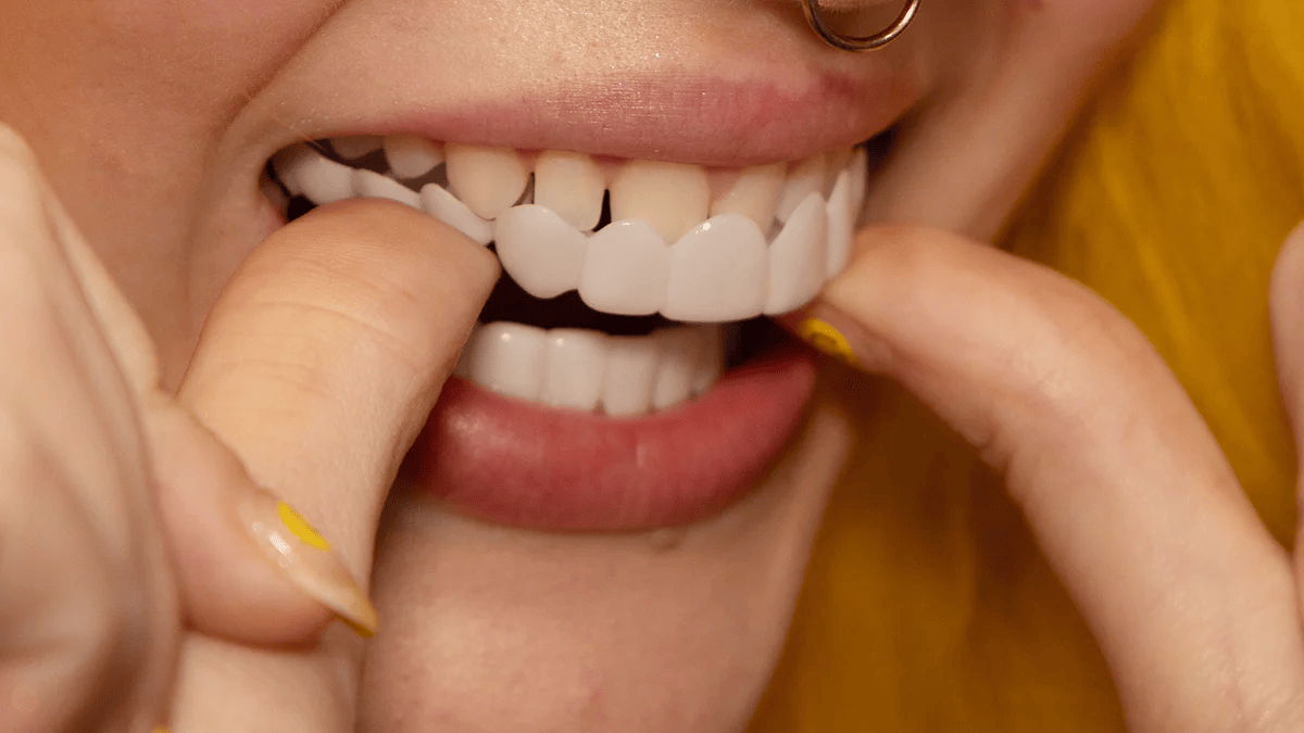 Mains ajustant des facettes sur des dents
